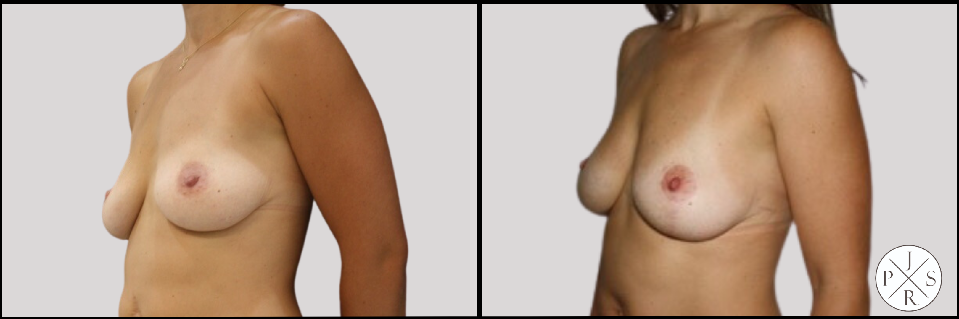 Fat Transfer Breast Augmentation Before & After Image